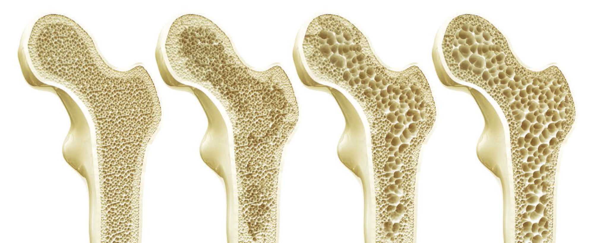 osteopénia, osteoporóza
